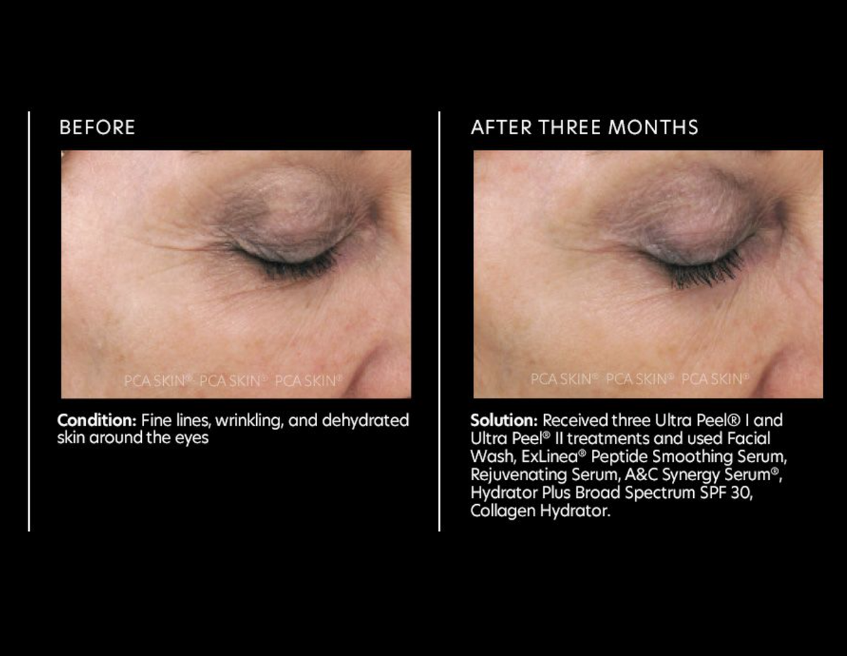 before and after