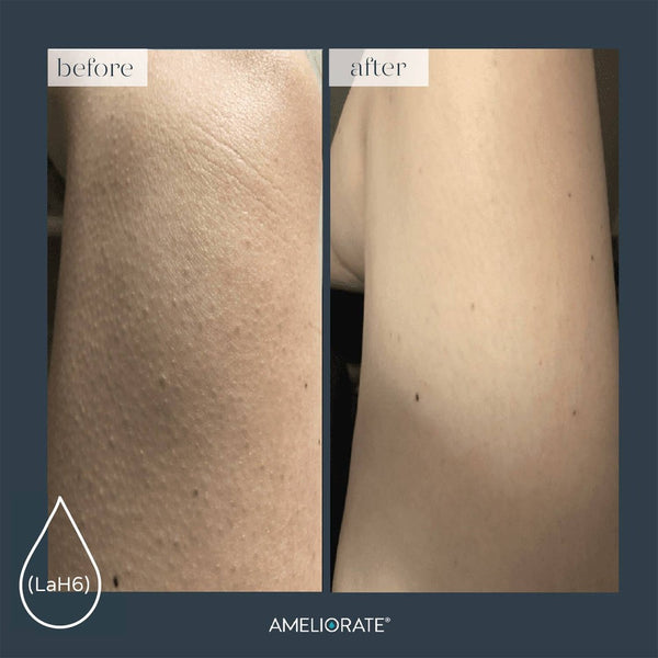 Before and after using Ameliorate Transforming Body Lotion
