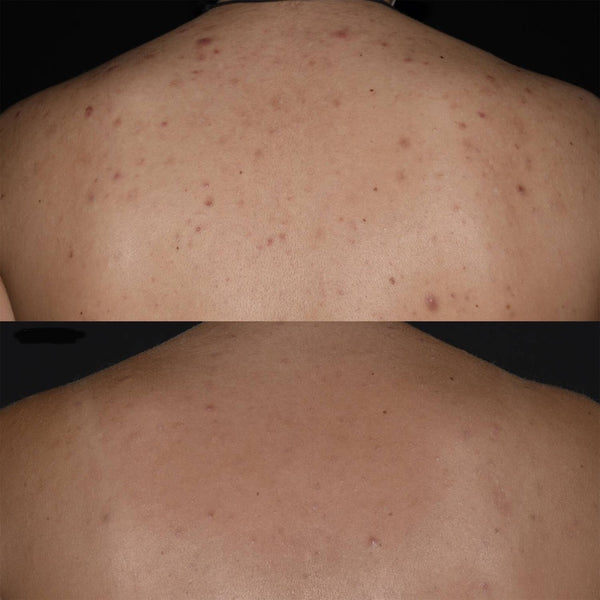 Before and after Ameliorate Transforming Clarity Body Spray 145ml