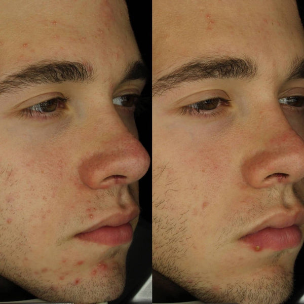 Before and after using Ameliorate Transforming Clarity Facial Serum 30ml