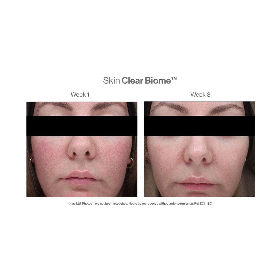 Before and after using Advanced Nutrition Programme Skin Clear Biome