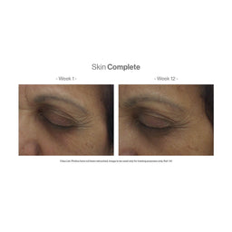 A before and after 12 weeks of using the product showing reduction in wrinkles. 